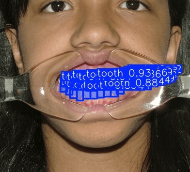 합성 증강 검출 결과